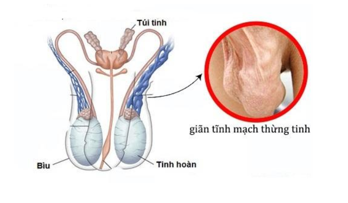 Giãn tĩnh mạch thừng tinh là gì?